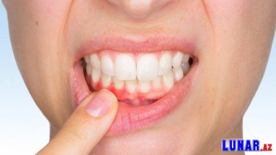 Diş əti xəstəliyini 4 qat artıran səbəb: infeksiya yaradır